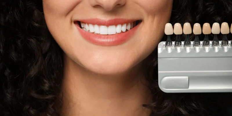 teeth whitening vs veneers