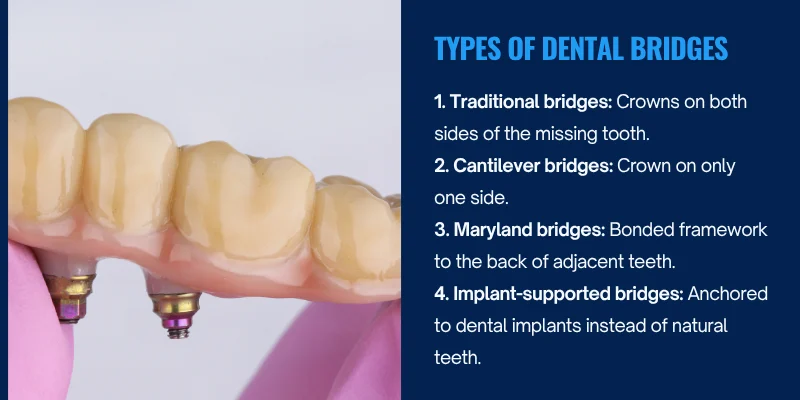 Types of dental bridges.