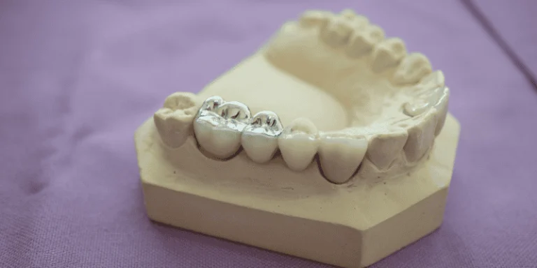 Porcelain vs. Composite Fillings