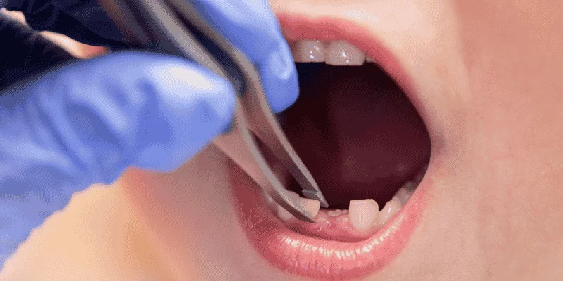 Extraction of Retained Baby Teeth