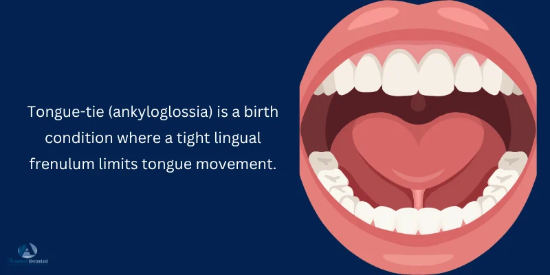 what-is-a-tongue-tie-ankyloglossia