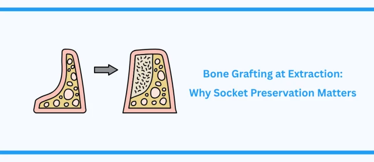 bone graft after tooth extraction
