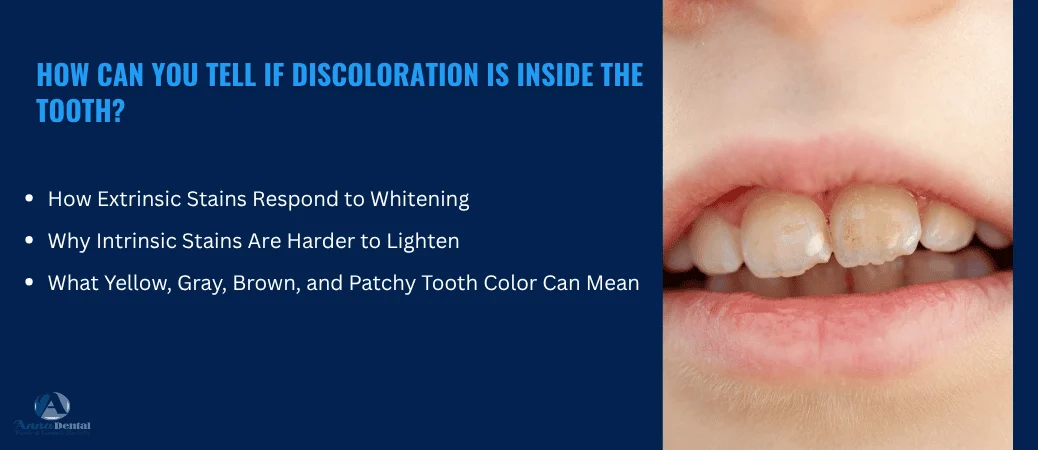 Is the Discoloration on the Surface or Inside the Tooth