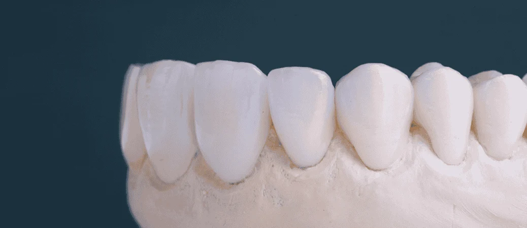 chipped front tooth treatment options