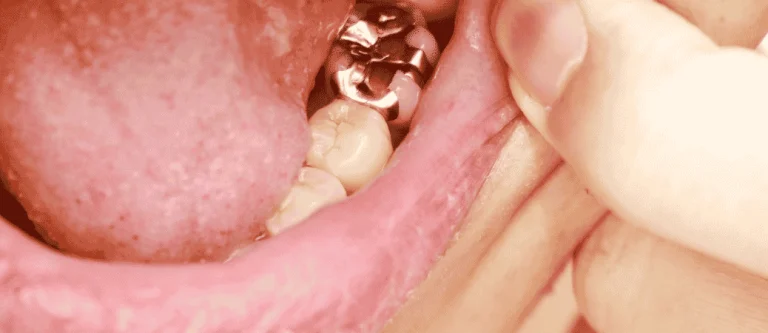 silver fillings vs composite fillings
